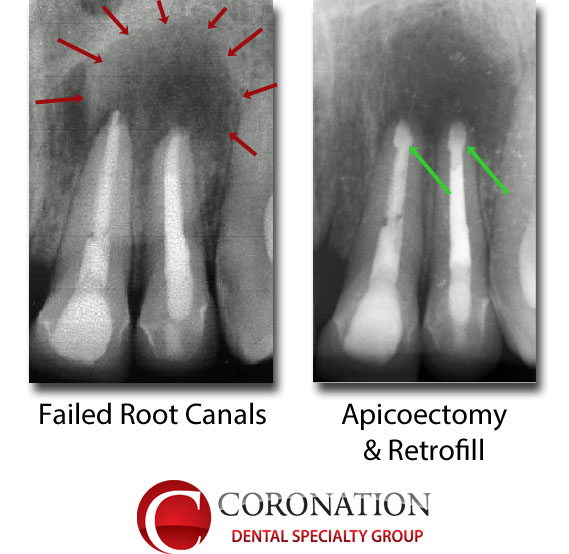 root endo meaning