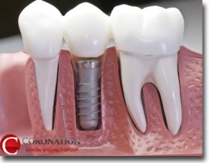Comparison of implant to natural teeth