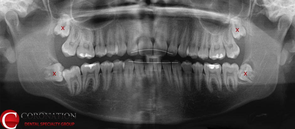 impacted wisdom tooth