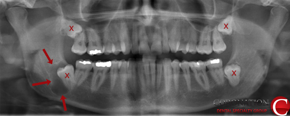 impacted wisdom tooth